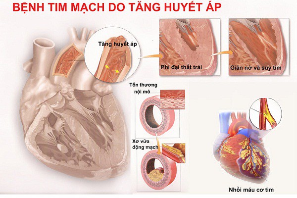 Cao huyết áp không làm điều này kẻo có ngày đột quỵ mất mạng