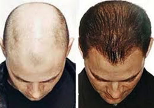 Bệnh rụng tóc ở nam giới