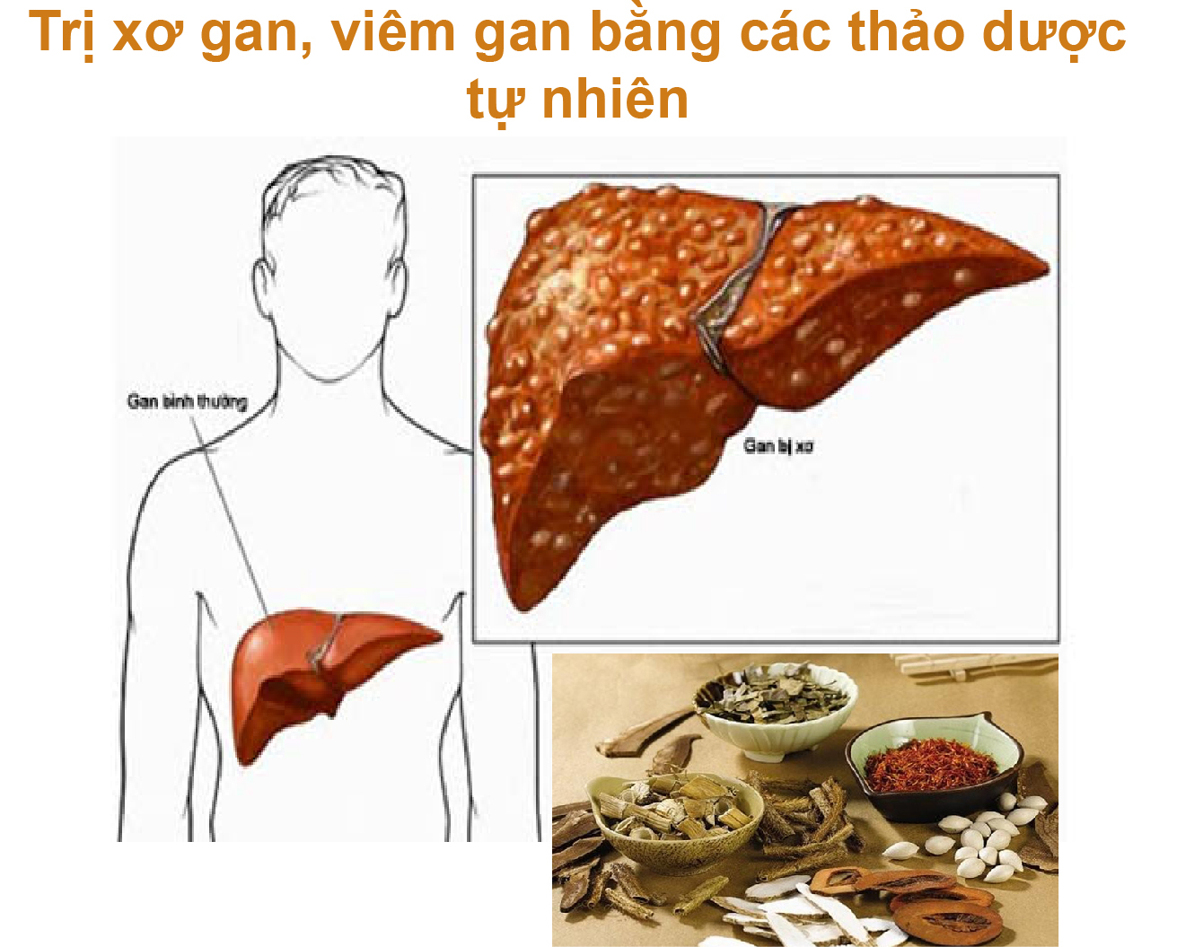 Trị viêm gan, xơ gan bằng các thảo dược tự nhiên!