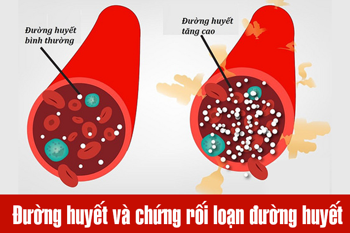 Đường huyết và chứng rối loạn đường huyết