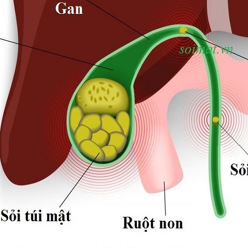 Ăn uống và sinh hoạt một cách khoa học có thể phòng chống sỏi mật