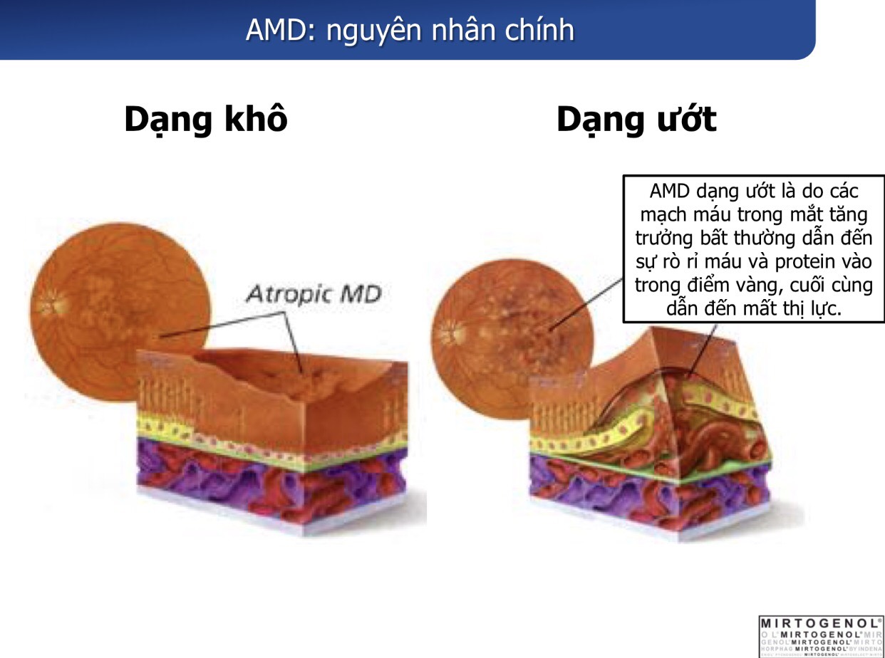 Super Lutein Mirto Plus phòng và hỗ trợ bệnh Thoái Hoá Điểm Vàng AMD