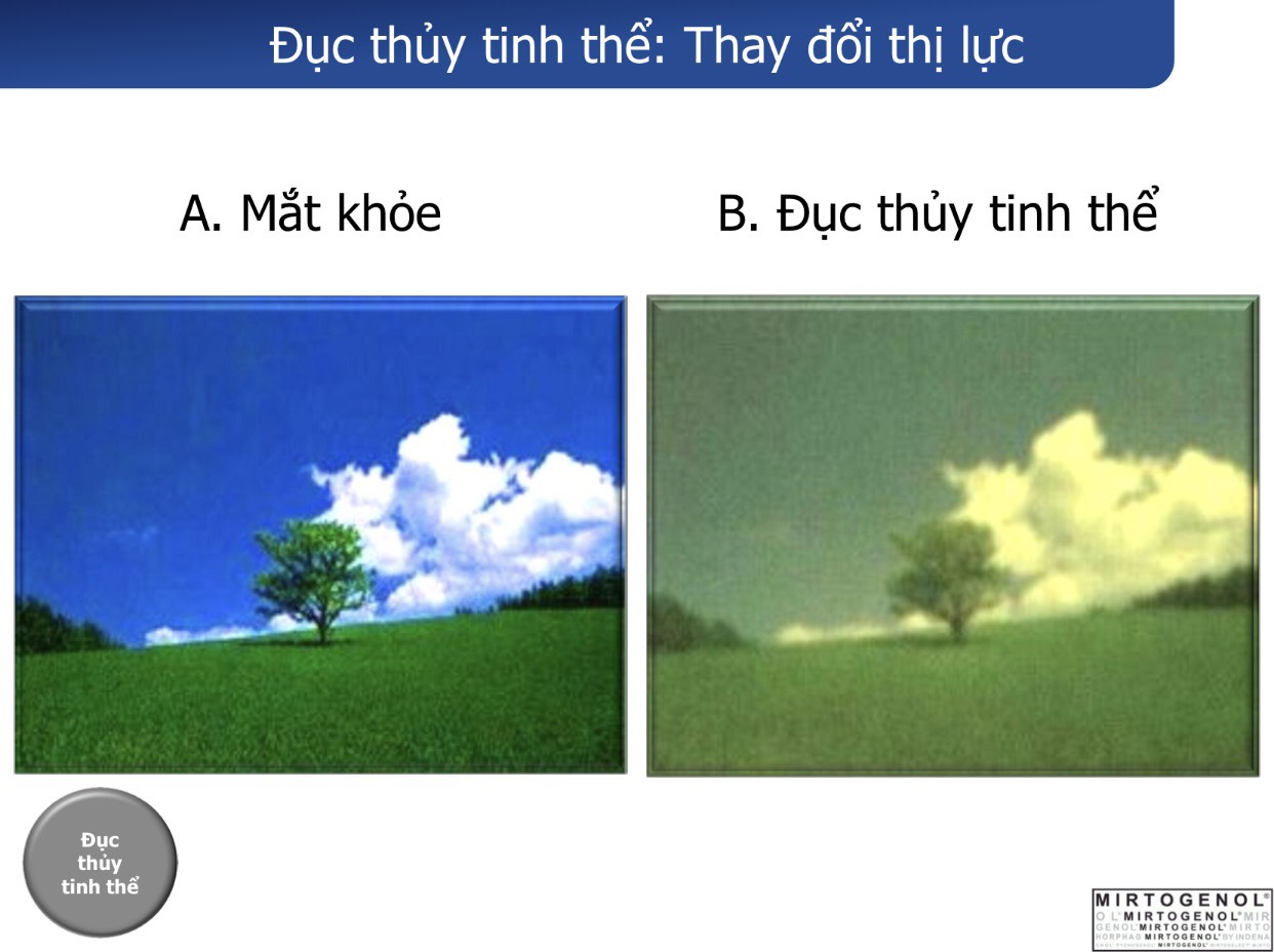 Super Lutein Mirto Plus giải pháp số một cho Mắt bị Đục thủy tinh thể