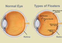 Floater ruồi bay trong mắt và Làm thế nào để thoát khỏi tình trạng này