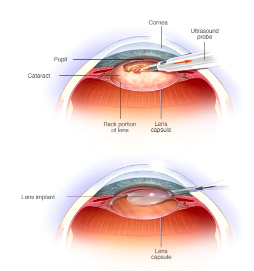 SUPER LUTEIN MIRTOPLUS giảp pháp số 1 cho bệnh đục thuỷ tinh thể