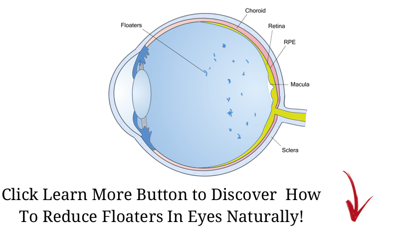 Super Lutein hiệu quả với bệnh (Floaters )ruồi bay mắt