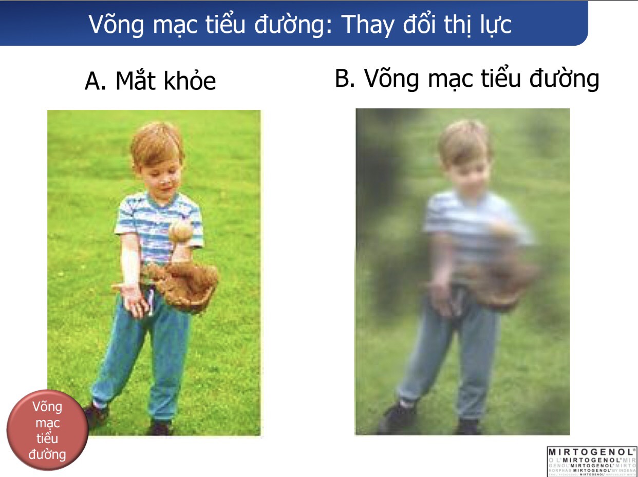 Nước Thần Kỳ  Izumio và Super lutein Mirto plus giải pháp tối ưu cho người bị tiểu đường