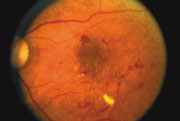 https://bizweb.dktcdn.net/100/107/356/files/diabet-retina-180px.jpg?v=1518338155827