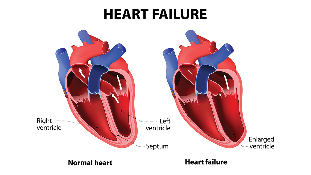 Heart-failure