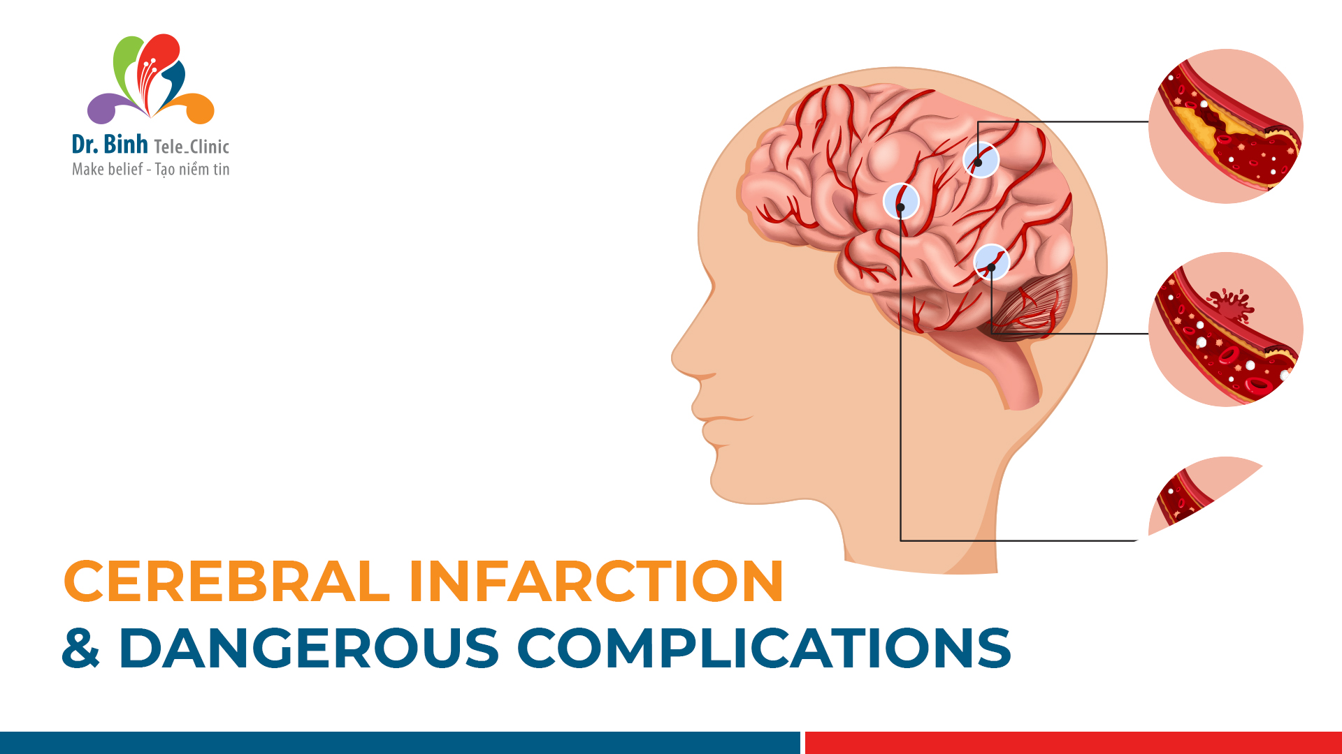 Dangerous complications of cerebral infarction