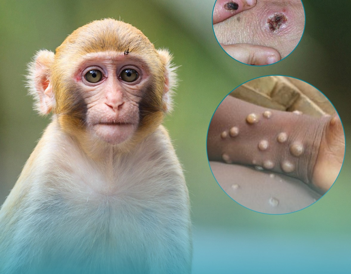 The dangers of monkeypox