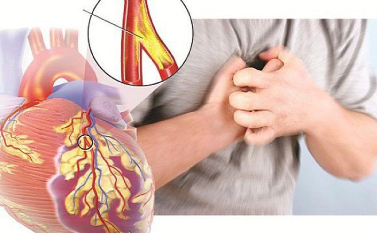 coronary-artery-disease