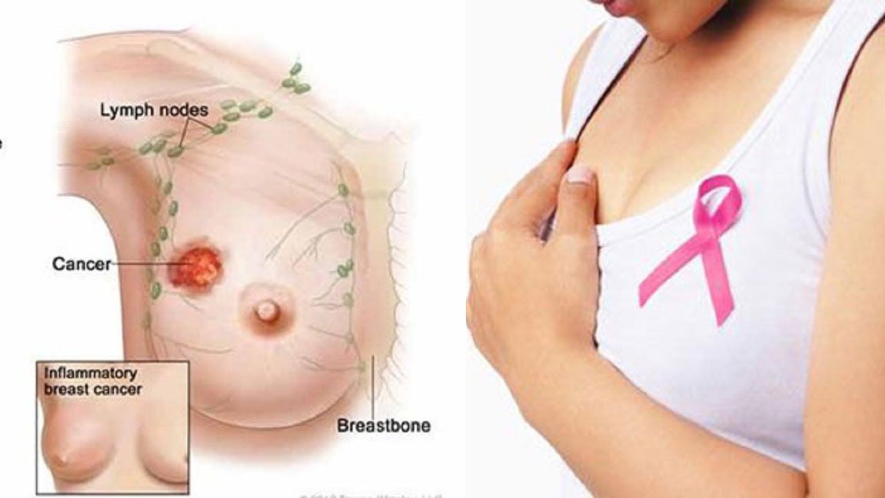 Breast-Cancer