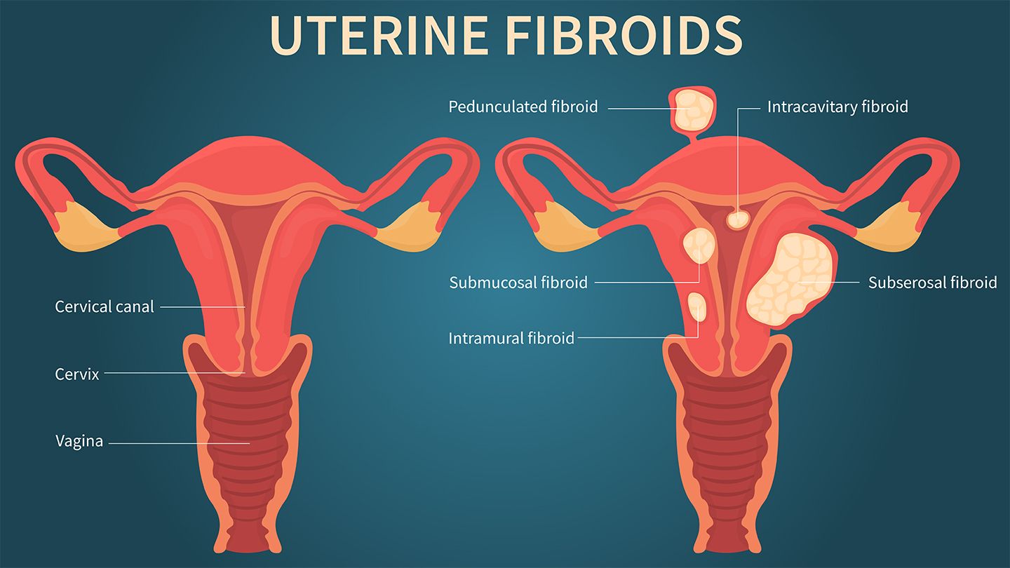 Uterine-fibroids-how-danger?