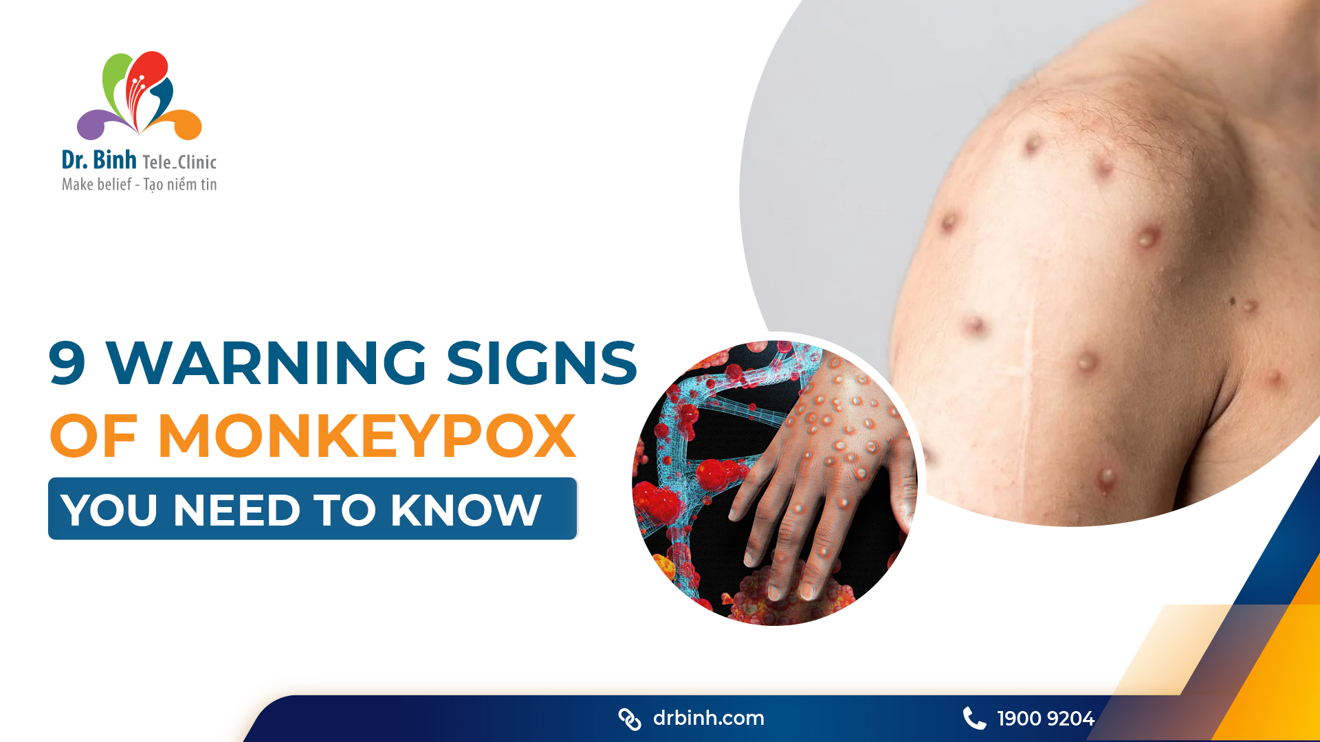 Signs of monkeypox