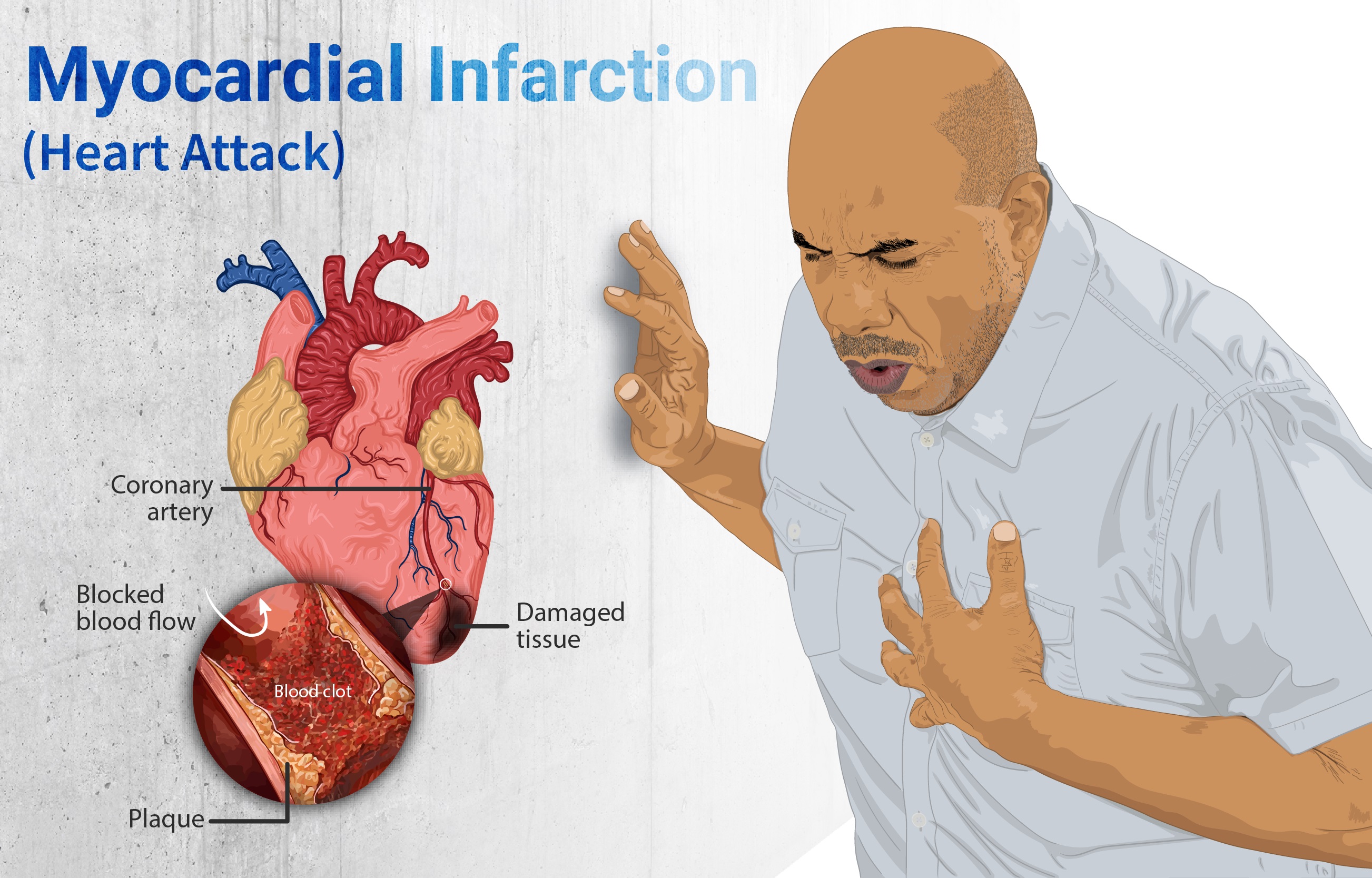 Myocardial-Infarction