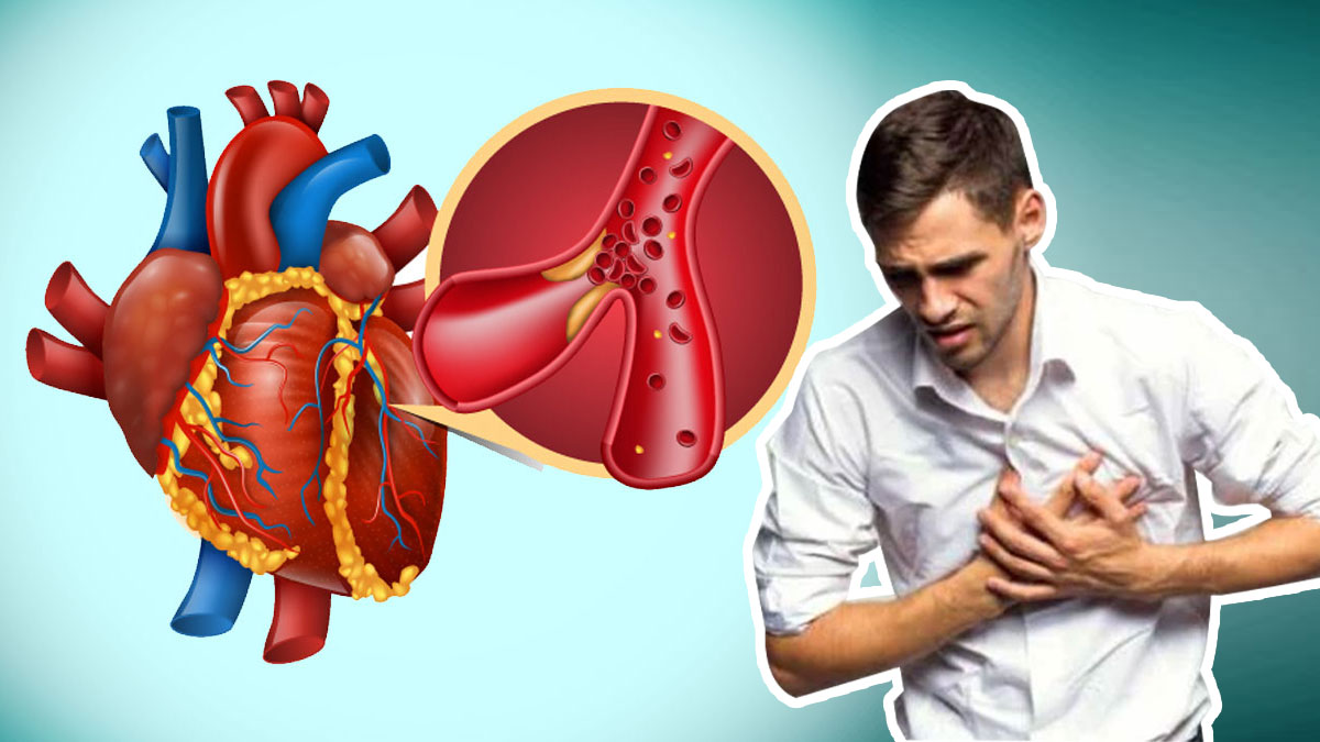 Myocardial-ischemia