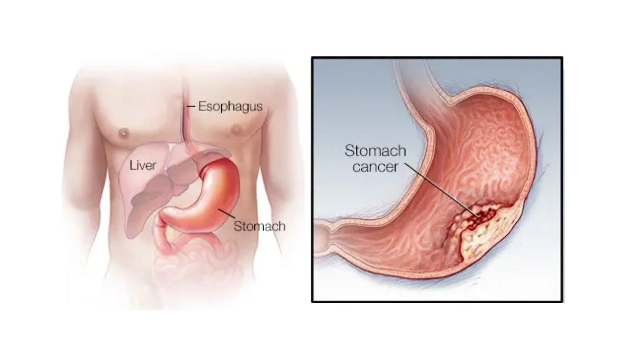  why-more and more people-have-stomach cancer