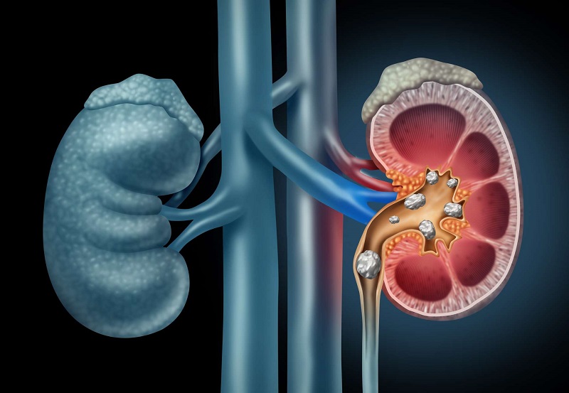 types of urinary stones