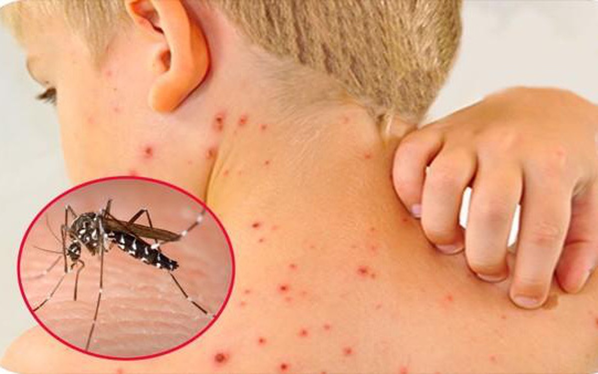 Dengue-fever-in-children