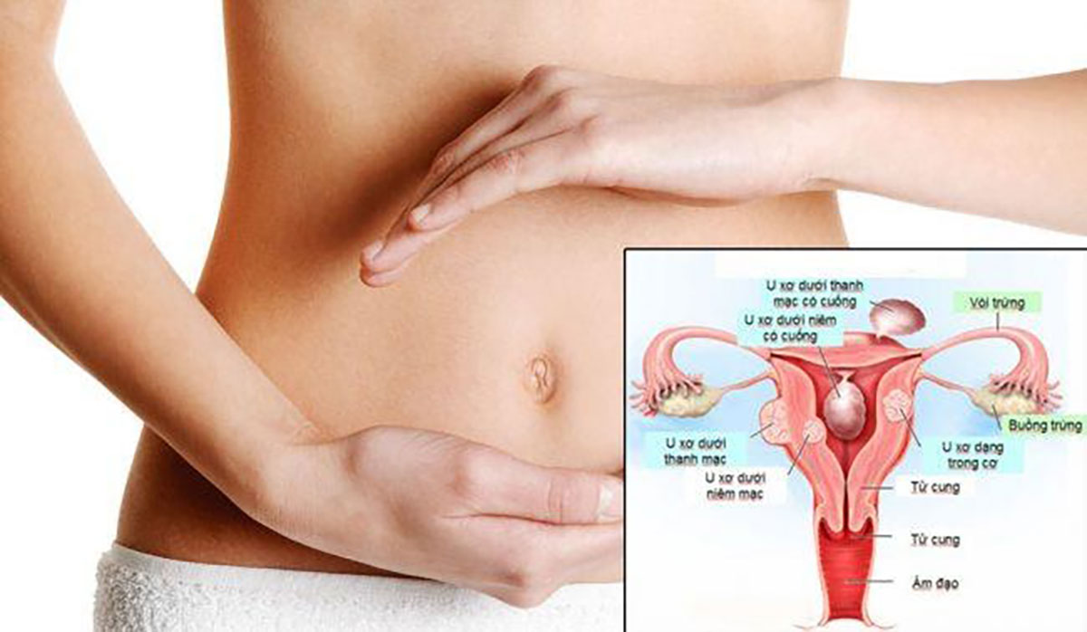  Uterine-fibroids-sign