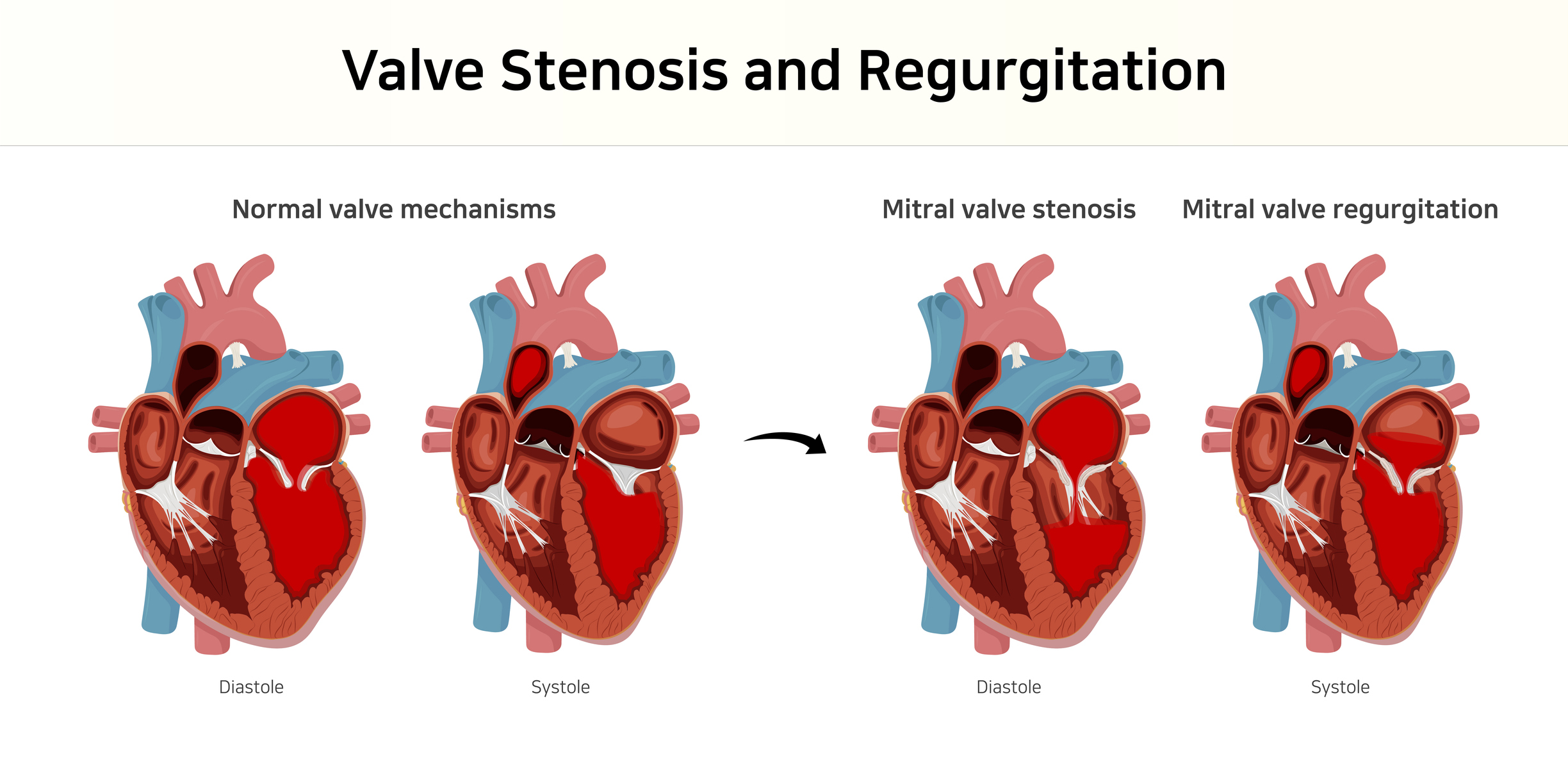 valvular-stenosis