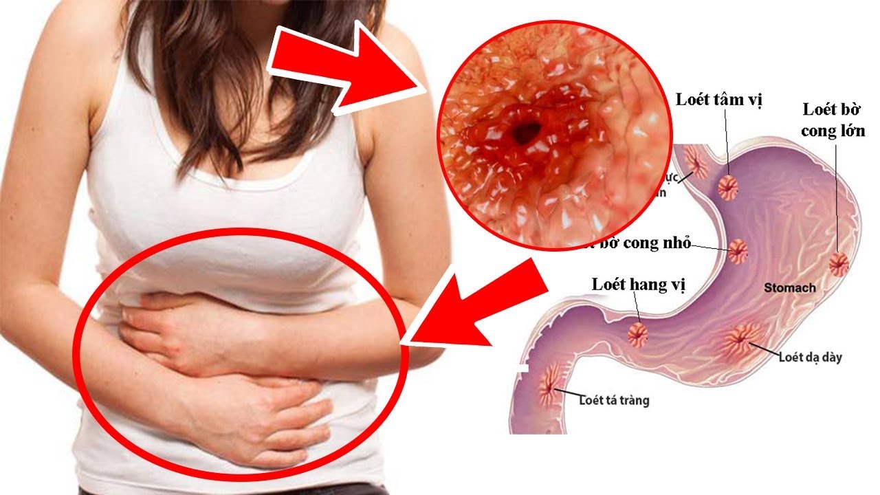  stomach-cancer-end-stage