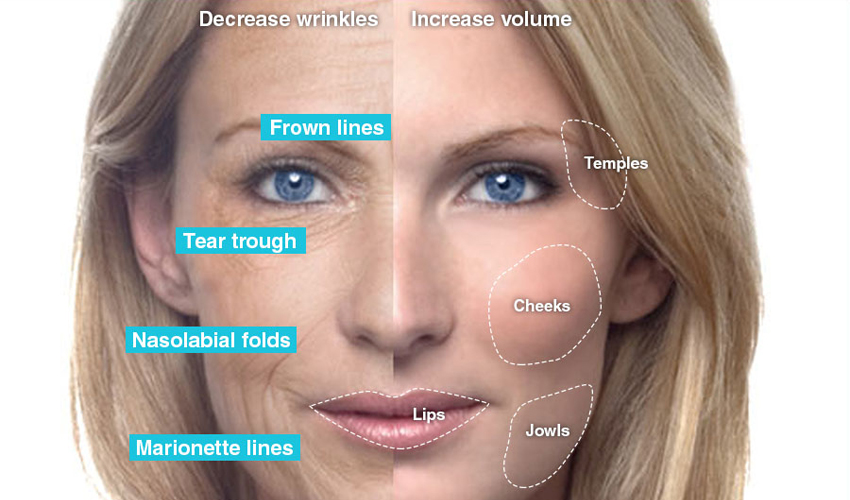 Điều trị nếp nhăn bằng Botox