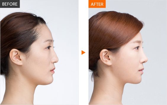 Vì sao Hàn Quốc là nơi lý tưởng cho phẫu thuật sửa lại mũi?
