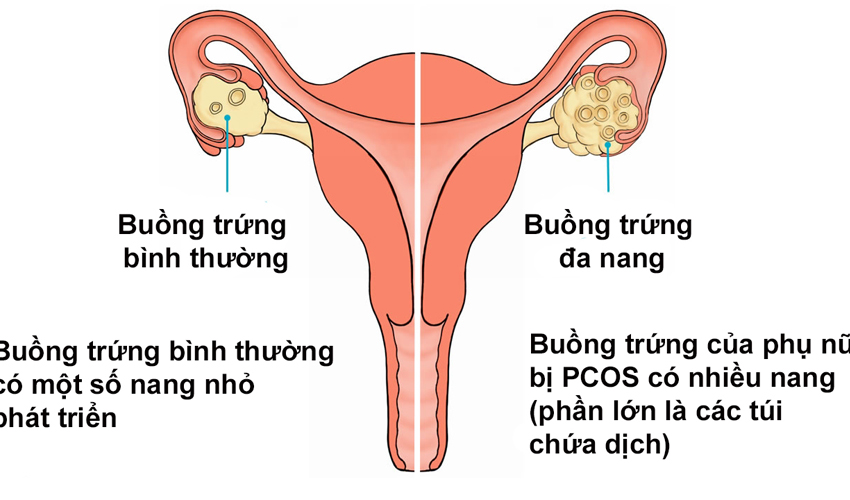 Vô sinh hiếm muộn vì buồng trứng đa nang?