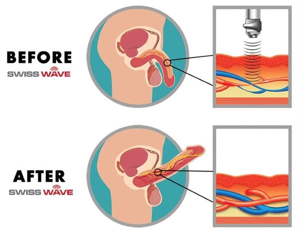 ĐIỀU TRỊ RỐI LOẠN CƯƠNG DƯƠNG BẰNG SÓNG XUNG KÍCH