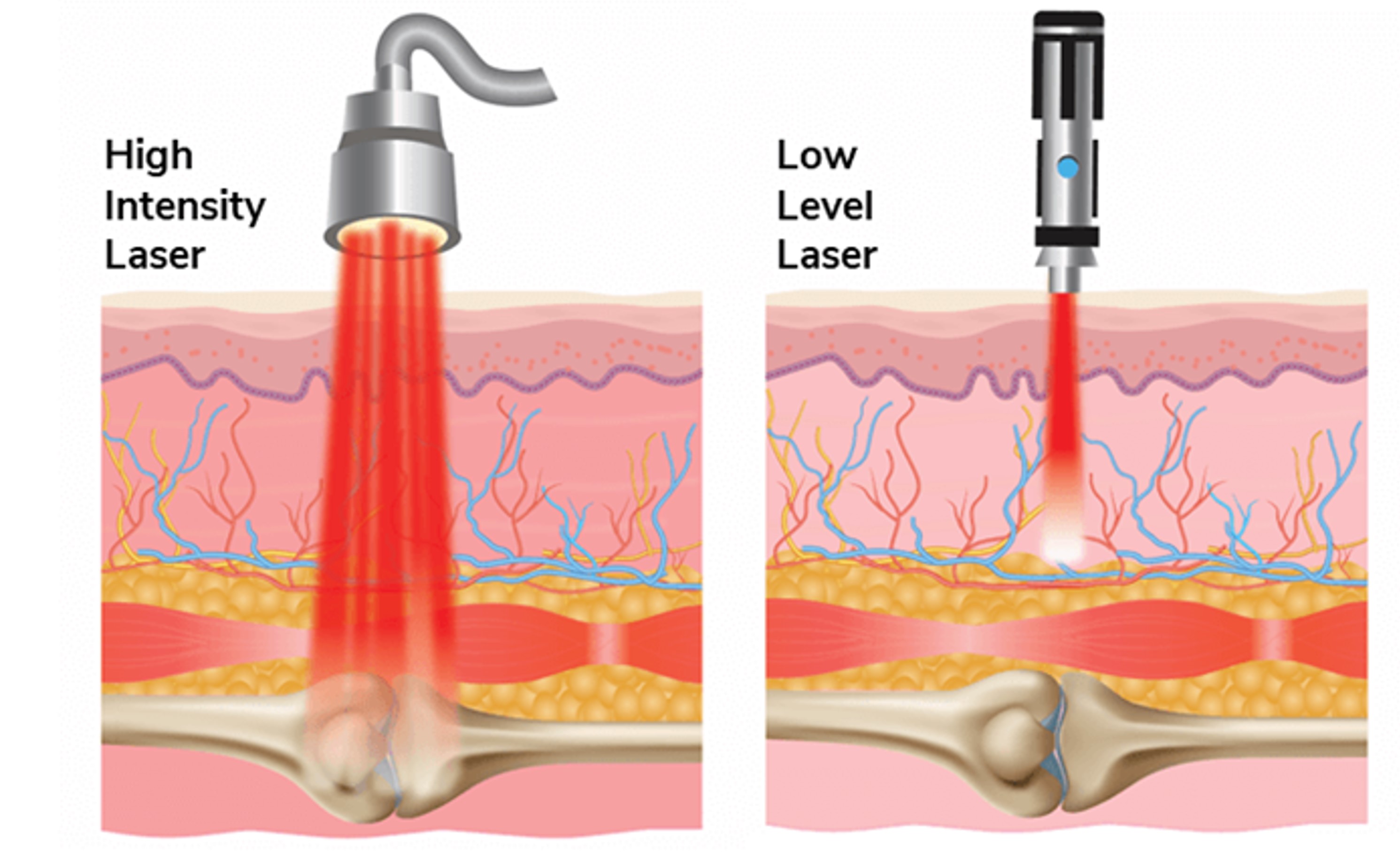 So sánh laser công suất cao và công suất thấp