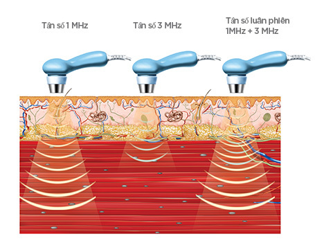 Ý NGHĨA TẦN SỐ 1MHz VÀ 3MHz TRONG SIÊU ÂM TRỊ LIỆU