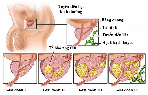 Chữa Bệnh U Xơ Tiền Liệt Tuyến Bằng Lá Trinh Nữ Hoàng Cung, Đơn Giản Mà Hiệu Quả