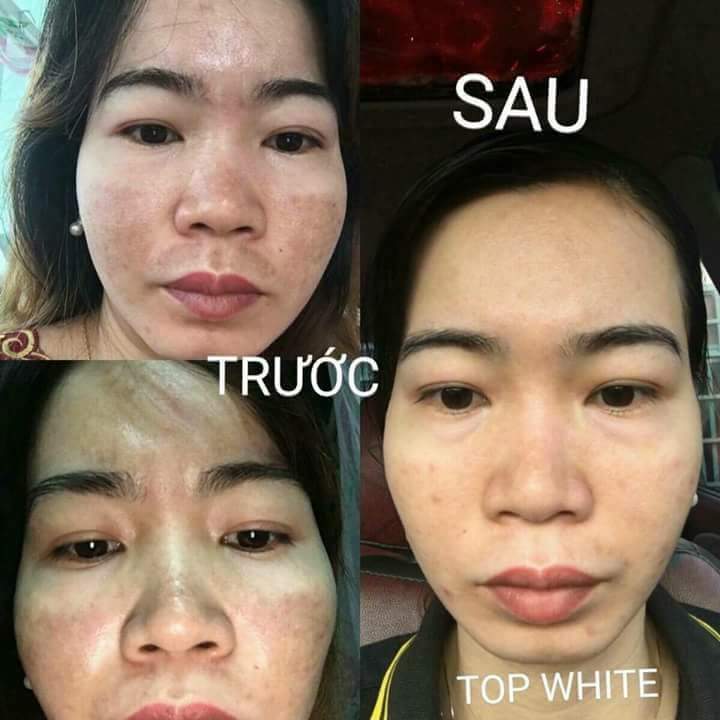 TOP WHITE ĐẶC TRỊ NÁM, TÀN NHANG HIỆU QUẢ.