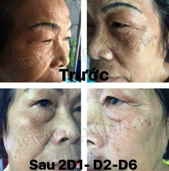 🌹🌹🌹CƠ CHẾ TẨY TẾ BÀO CHẾT TRÊN DA  CỦA WHITE PERFECT D1 CÓ AN TOÀN KHÔNG???💕💕💕