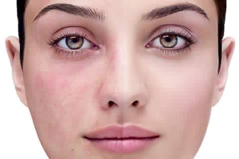 5 VẤN ĐỀ CẦN CHÚ Ý KHI CHĂM SÓC DA NHẠY CẢM