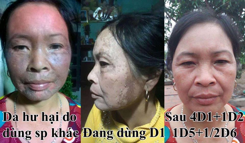 “10 NĂM NÁM ĐEN DA MẶT, TÔI BẬT KHÓC TRƯỚC THAY ĐỔI QUÁ LỚN SAU 3 THÁNG TÌM ĐẾN TOP WHITE”