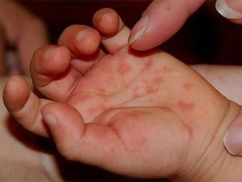 BỆNH TAY CHÂN MIỆNG CÓ GÌ NGUY HIỂM?