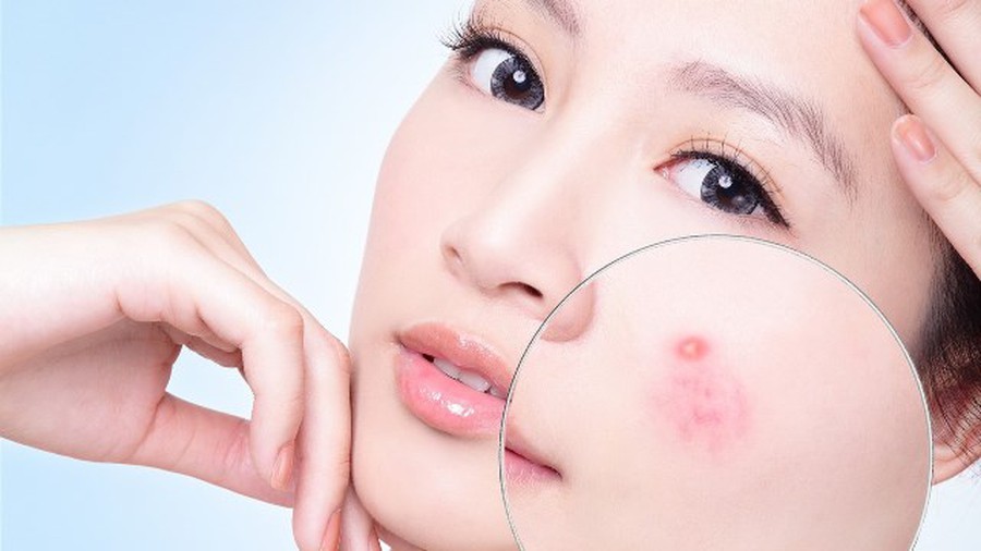 Da bị mụn có nên dùng sữa rửa mặt hay không?!