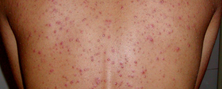 Nguyên nhân và cách chữa trị mụn mọc ở lưng