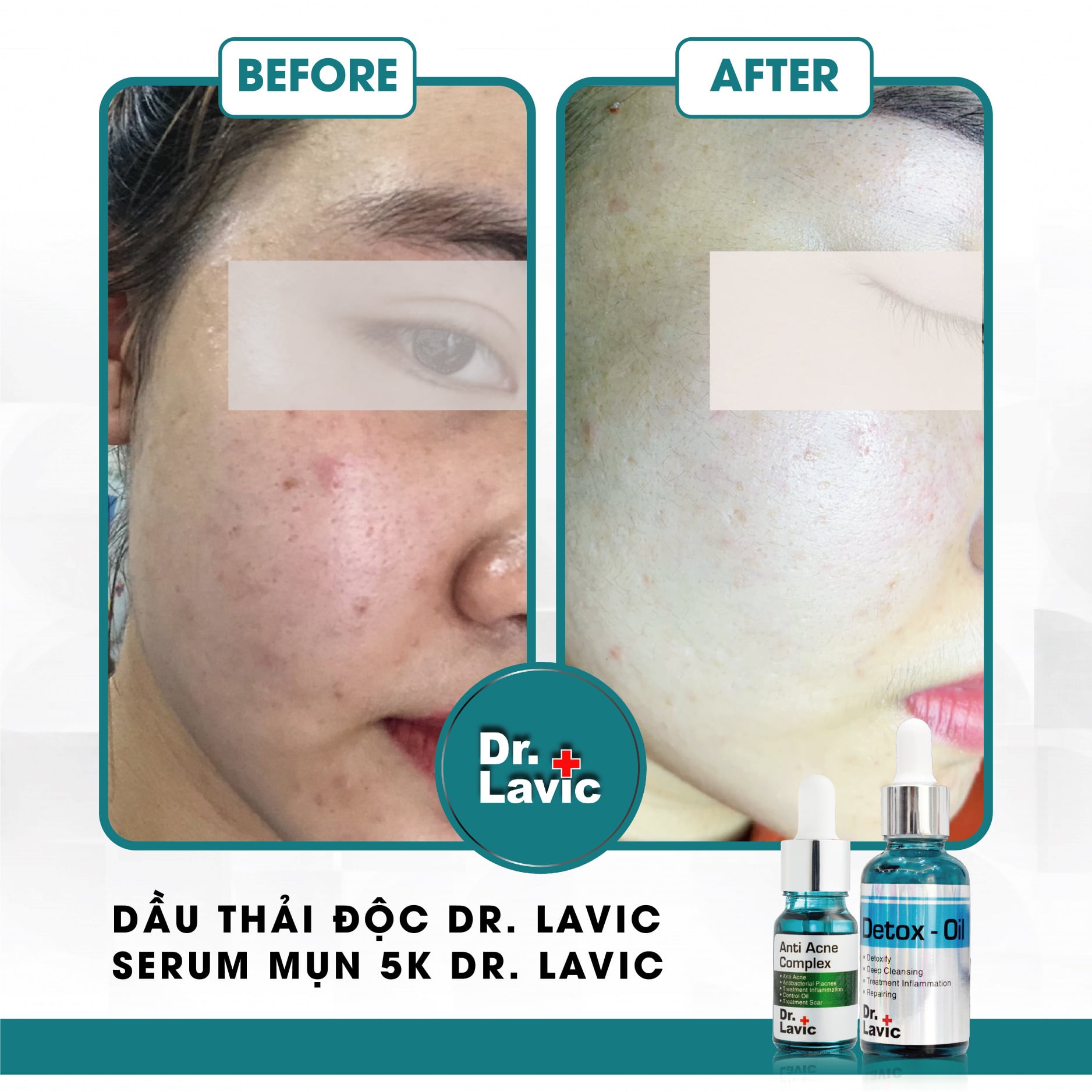 Dầu thải độc tố, giảm tiết bã nhờn, giảm sưng viêm Se Khít Lỗ Chân Lông Công Nghệ USA DR.LAVIC Detox - Oil 30ML - DR913M