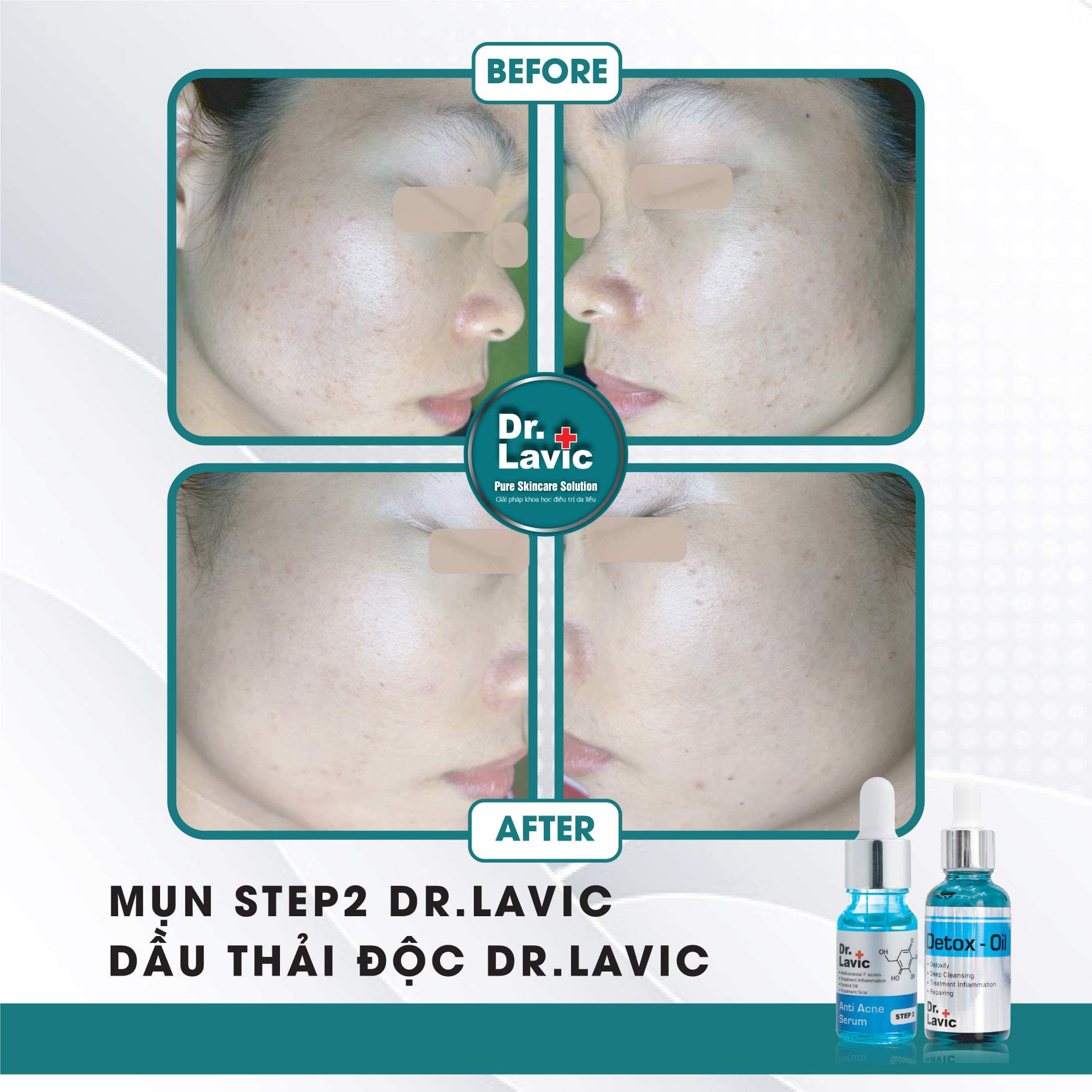Dầu thải độc tố, giảm tiết bã nhờn, giảm sưng viêm Se Khít Lỗ Chân Lông Công Nghệ USA DR.LAVIC Detox - Oil 30ML - DR913M