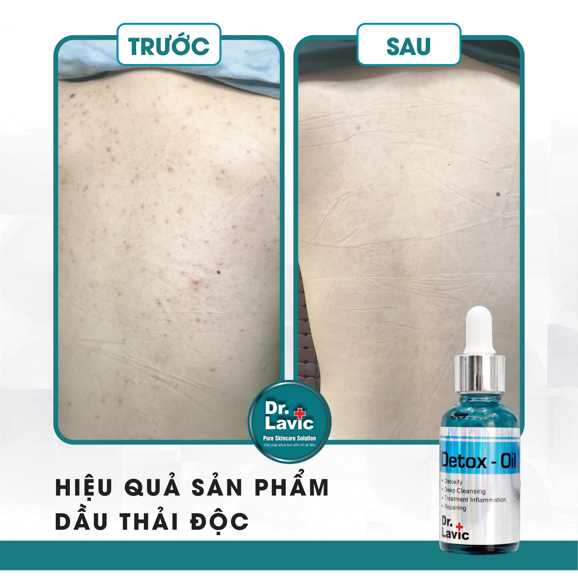 Dầu thải độc tố, giảm tiết bã nhờn, giảm sưng viêm Se Khít Lỗ Chân Lông Công Nghệ USA DR.LAVIC Detox - Oil 30ML - DR913M