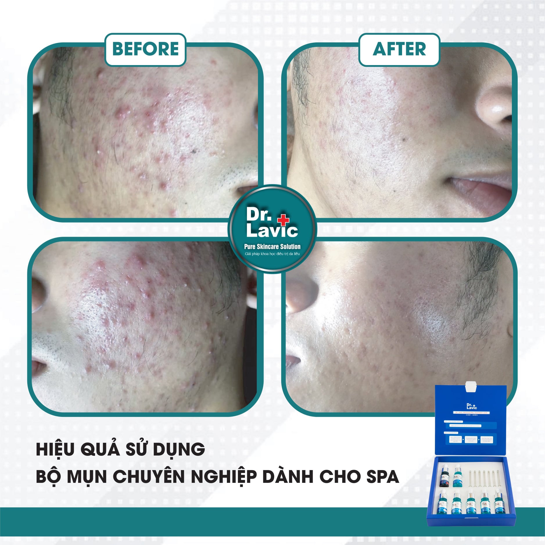 Bộ mụn chuyên nghiệp Professional Treatment Acne - DR.LAVIC DR905