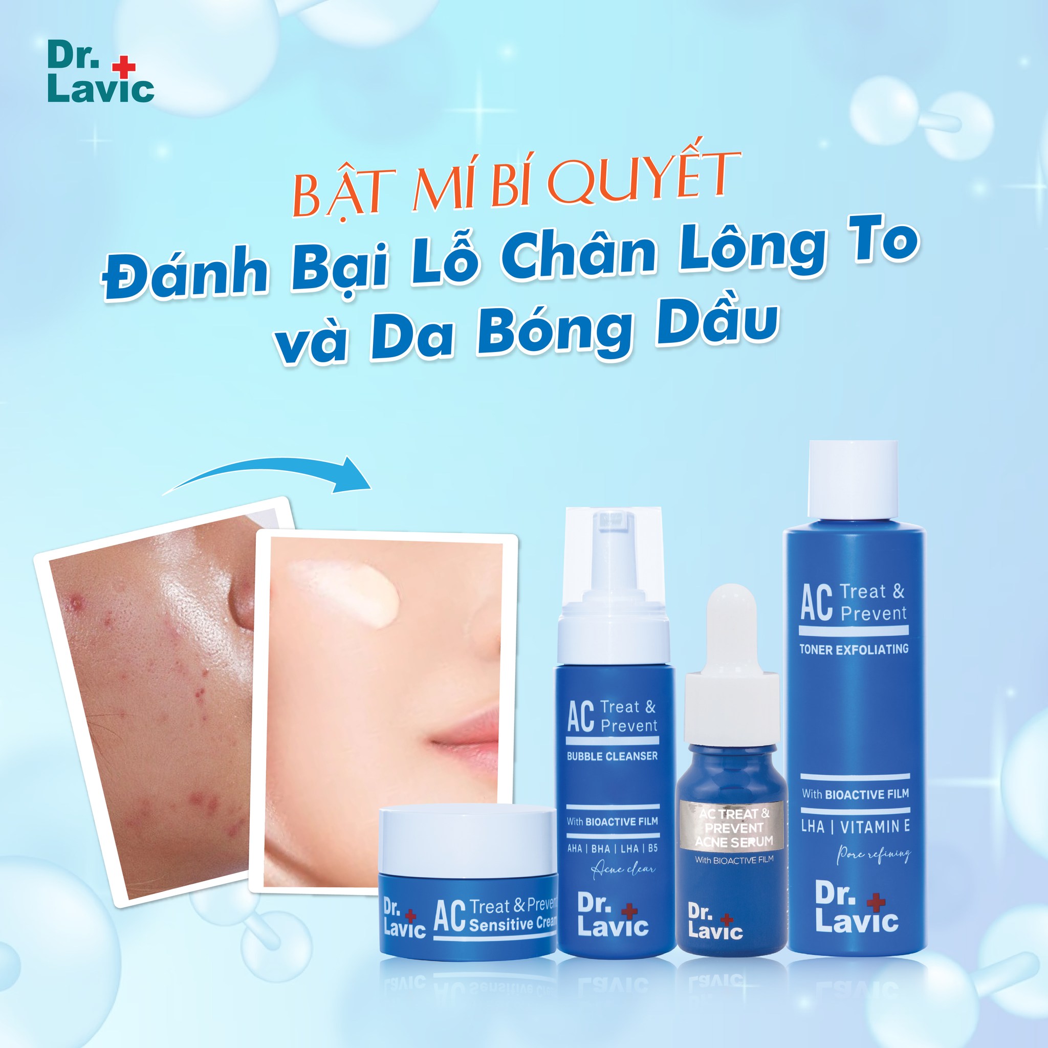 Bộ 4 sản phẩm ngừa mụn Dr.Lavic Acne Home Care kiểm soát dầu sử dụng tại nhà DR961