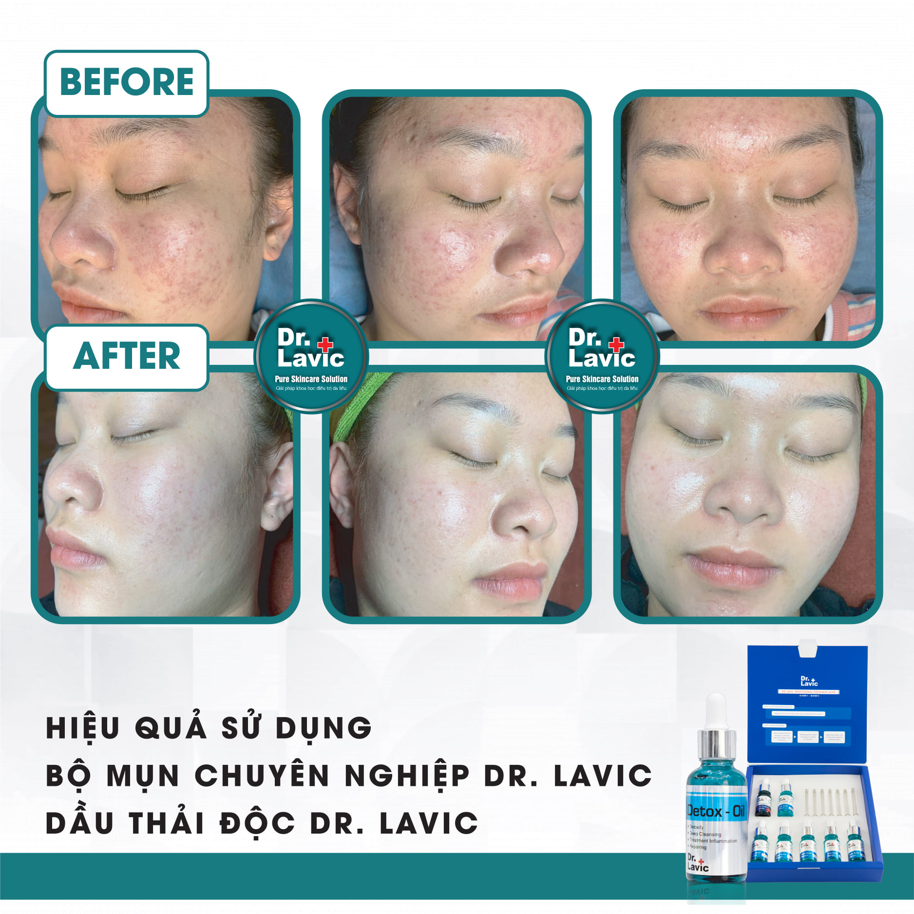 Bộ mụn chuyên nghiệp Professional Treatment Acne - DR.LAVIC DR905