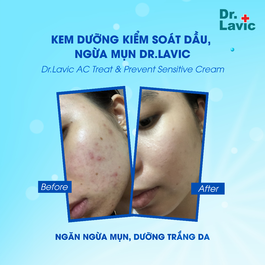 Kem dưỡng ẩm ngừa mụn Dr.Lavic AC Treat & Prevent Sensitive Cream kiềm dầu, chống tái phát mụn 20g DR959