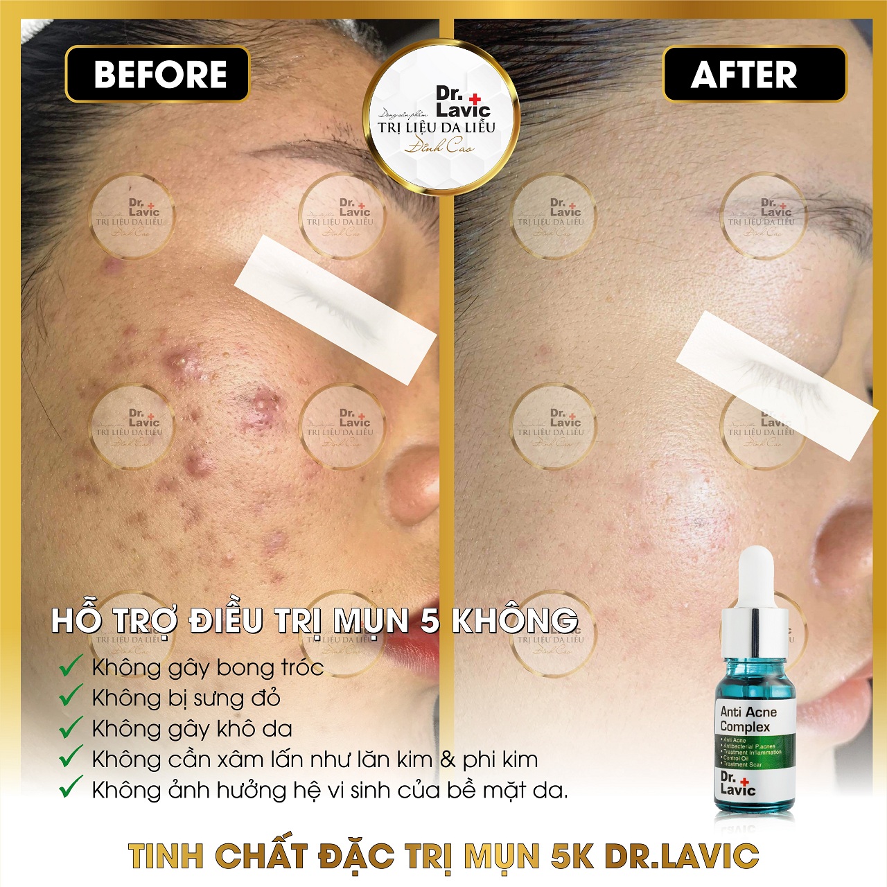 Serum Trị Mụn Dưỡng Ẩm Trắng Da Thu Nhỏ Lỗ Chân Lông Công Nghệ USA DR.LAVIC Anti Acne Complex 5ML - DR906