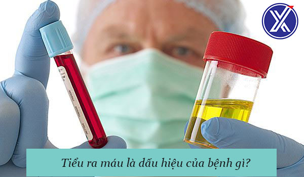 TIỂU RA MÁU LÀ DẤU HIỆU CỦA BỆNH GI?